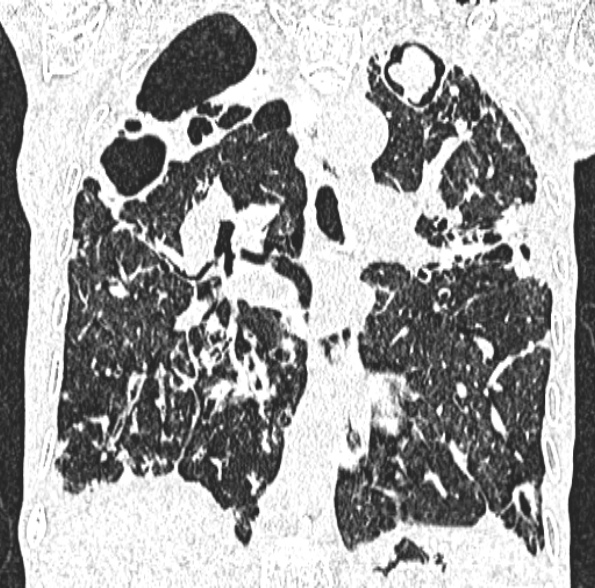 Aspergilloma- with Monod sign (Radiopaedia 44737-48532 Coronal lung window 264).jpg