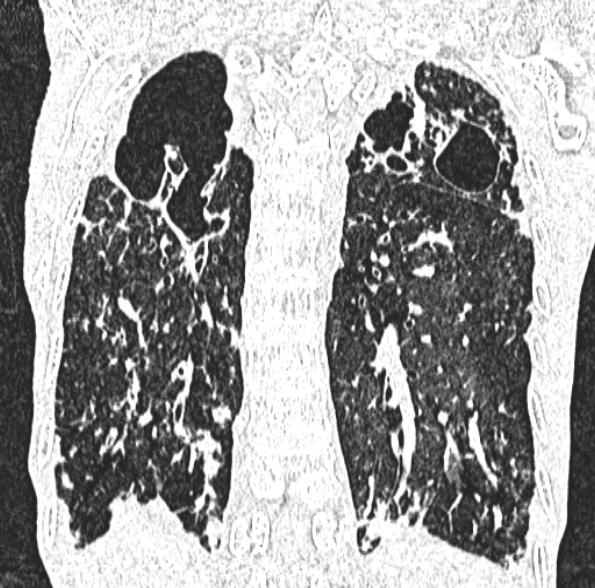 Aspergilloma- with Monod sign (Radiopaedia 44737-48532 Coronal lung window 338).jpg