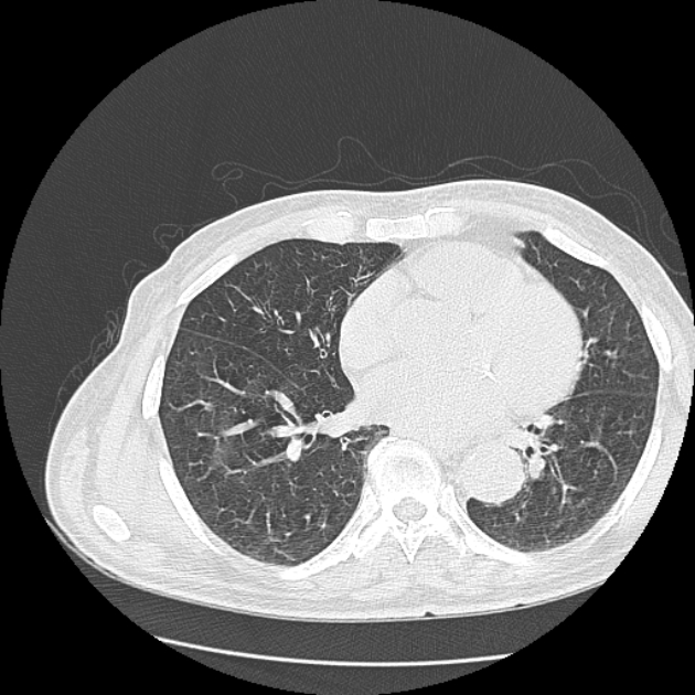 Aspergilloma (Radiopaedia 44592-48327 Axial lung window 56).jpg