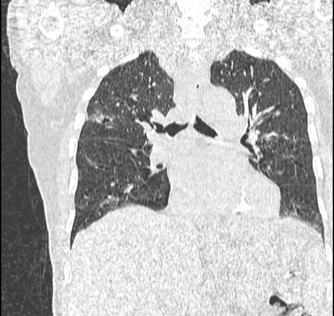 Aspergilloma (Radiopaedia 44592-48327 Coronal lung window 66).jpg