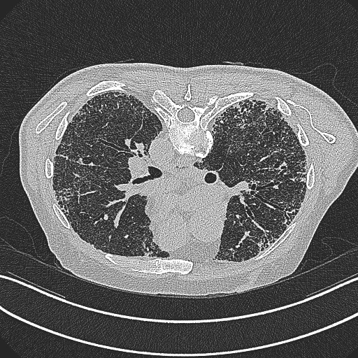 File:Aspergilloma on background pulmonary fibrosis (Radiopaedia 60942-68757 Axial lung window 7).jpg