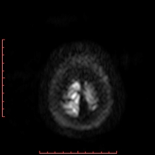 Astroblastoma (Radiopaedia 74287-85162 Axial DWI 107).jpg