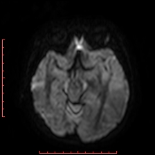 Astroblastoma (Radiopaedia 74287-85162 Axial DWI 38).jpg