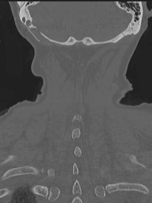 Atlanto-axial subluxation (Radiopaedia 36610-38176 Coronal bone window 44).png