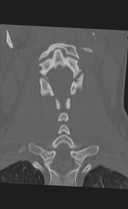Atlanto-occipital dissociation (Radiopaedia 33848-35013 Coronal bone window 25).png