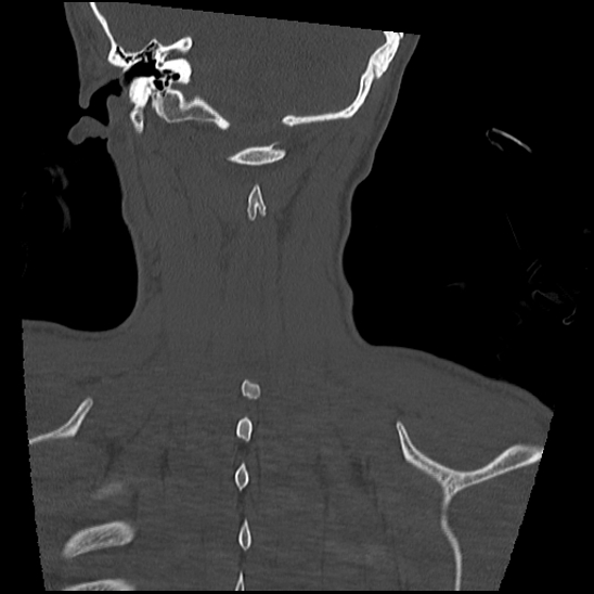 Atlanto-occipital dissociation (Traynelis type 1), C2 teardrop fracture, C6-7 facet joint dislocation (Radiopaedia 87655-104061 Coronal bone window 58).jpg