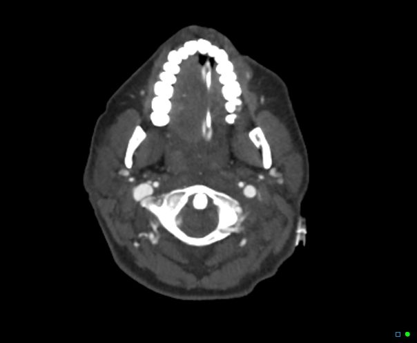 Atlanto-occipital dissociation - Traynelis type 1 (Radiopaedia 87570-103949 A 50).jpg