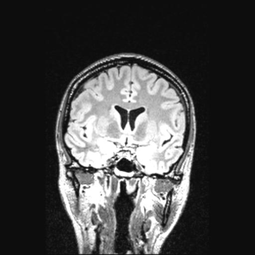 File:Atretic encephalocoele with inferior vermis hypoplasia (Radiopaedia 30443-31108 Coronal FLAIR 110).jpg