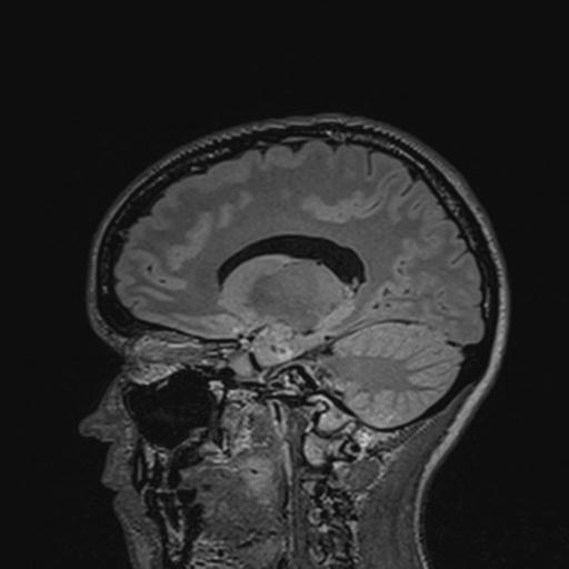 Atretic encephalocoele with inferior vermis hypoplasia (Radiopaedia 30443-31108 Sagittal FLAIR 68).jpg