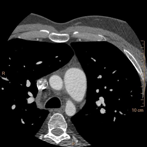 File:Atrial septal defect (upper sinus venosus type) with partial anomalous pulmonary venous return into superior vena cava (Radiopaedia 73228-83961 A 23).jpg