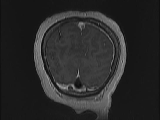 File:Atypical meningioma (Radiopaedia 62985-71406 Coronal T1 C+ 115).jpg
