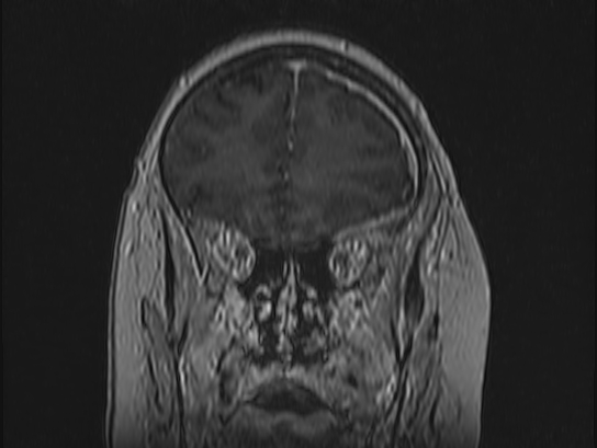 Atypical meningioma (Radiopaedia 62985-71406 Coronal T1 C+ 27).jpg