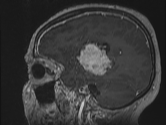 Atypical meningioma (Radiopaedia 62985-71406 Sagittal T1 C+ 66).jpg