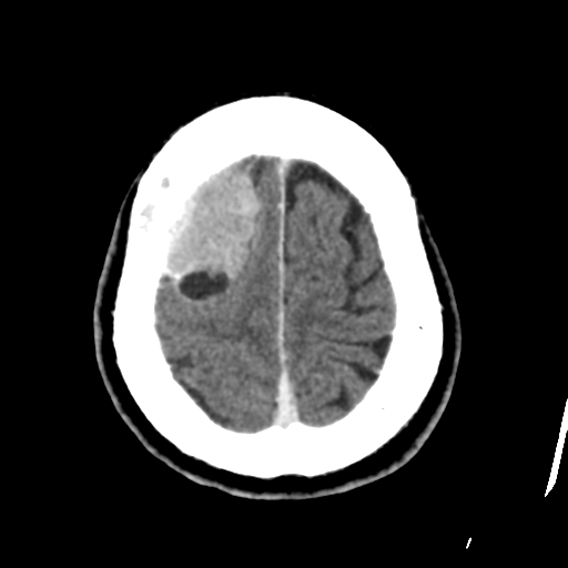 Atypical meningioma (WHO grade II) with osseous invasion (Radiopaedia 53654-59715 Axial C+ delayed 45).png