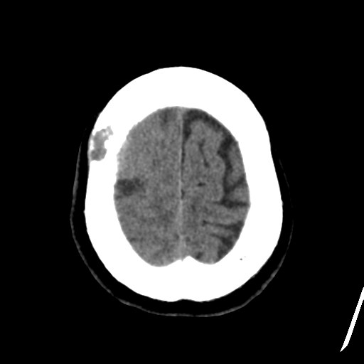Atypical meningioma (WHO grade II) with osseous invasion (Radiopaedia 53654-59715 Axial non-contrast 46).png