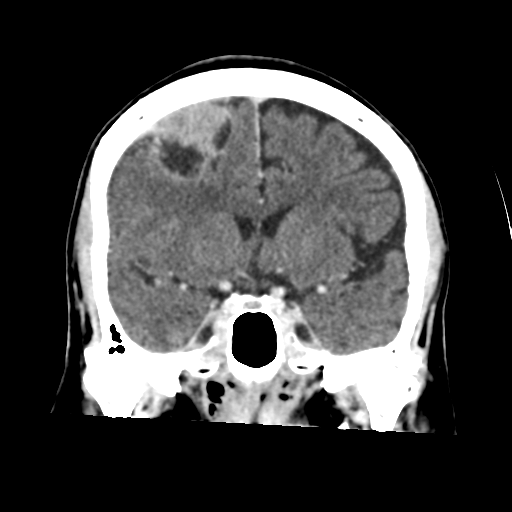 Atypical meningioma (WHO grade II) with osseous invasion (Radiopaedia 53654-59715 Coronal C+ delayed 26).png