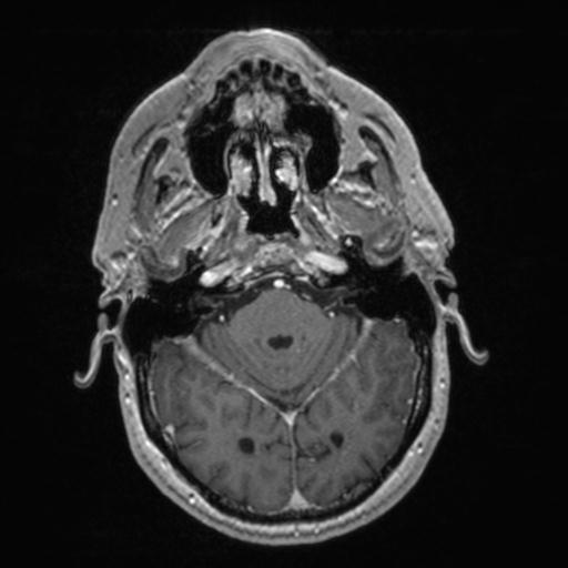 Atypical meningioma (grade II) - en plaque (Radiopaedia 29633-30147 Axial T1 C+ 58).jpg