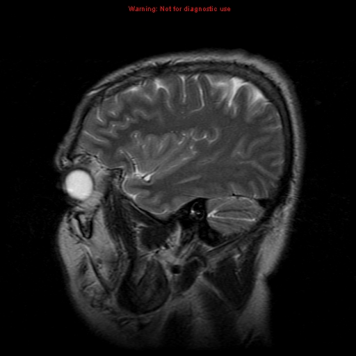 File:Atypical meningioma - grade II (Radiopaedia 13303-13305 Sagittal T2 18).jpg