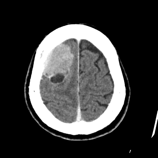 Atypical meningioma with skull invasion (Radiopaedia 34357-35649 Axial C+ delayed 44).png