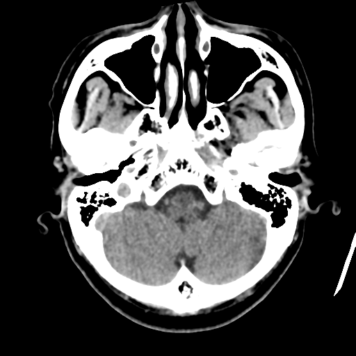 Atypical meningioma with skull invasion (Radiopaedia 34357-35649 Axial non-contrast 11).png