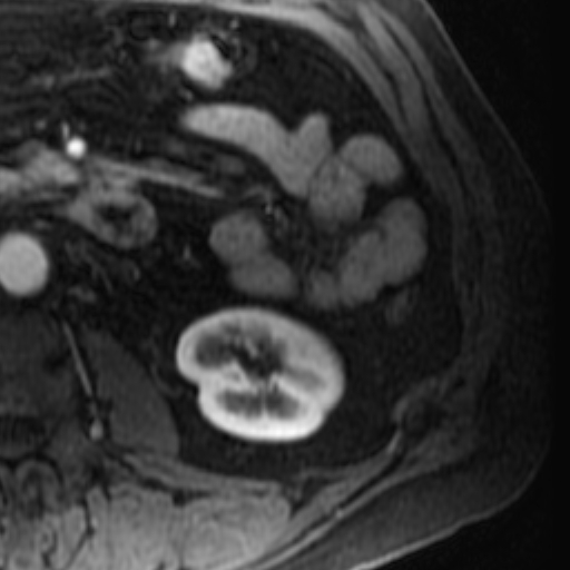 File:Atypical renal cyst on MRI (Radiopaedia 17349-17046 C 23).jpg