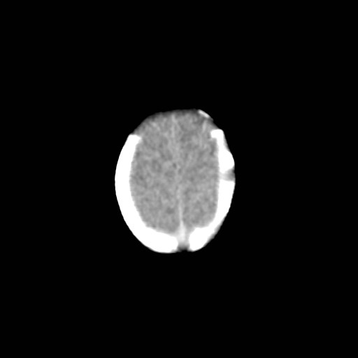File:Atypical teratoid rhabdoid tumor (prenatal US and neonatal MRI) (Radiopaedia 59091-66387 Axial non-contrast 35).jpg