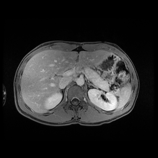 Autoimmune pancreatitis (Radiopaedia 69751-79729 Axial T1 C+ fat sat 51).jpg