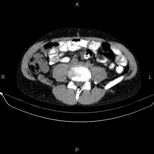 Autoimmune pancreatitis (Radiopaedia 84925-100431 Axial non-contrast 35).jpg