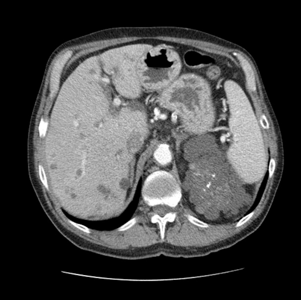 Autosomal dominant polycystic kidney disease (Radiopaedia 27851-28094 B 58).jpg