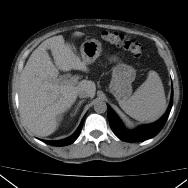 File:Autosomal dominant polycystic kidney disease (Radiopaedia 36539-38101 Axial non-contrast 20).jpg