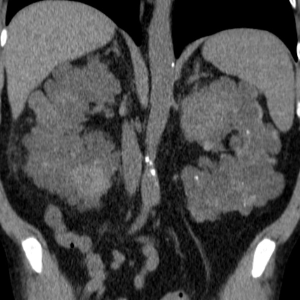 File:Autosomal dominant polycystic kidney disease (Radiopaedia 36539-38101 Coronal non-contrast 28).jpg