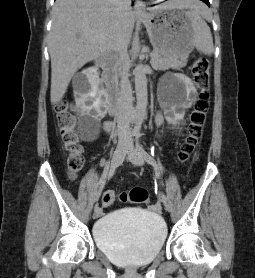 Autosomal dominant polycystic kidney disease (Radiopaedia 38189-40194 Coronal C+ delayed 43).jpg