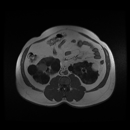 Autosomal dominant polycystic kidney disease (Radiopaedia 50259-55611 Axial 2D Dual Echo 56).jpg