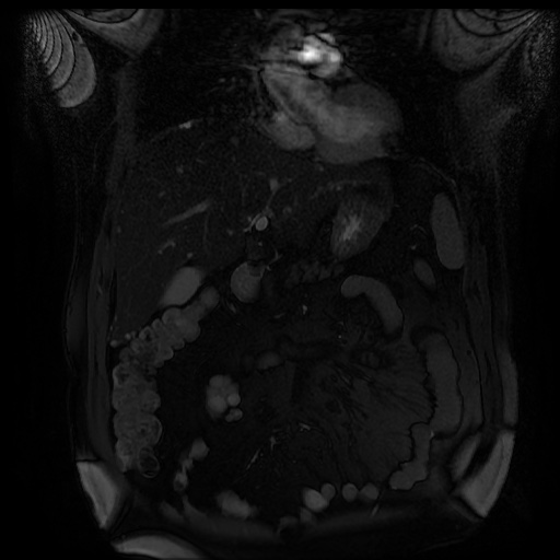 File:Autosomal dominant polycystic kidney disease (Radiopaedia 50259-55611 Coronal FIESTA 13).jpg