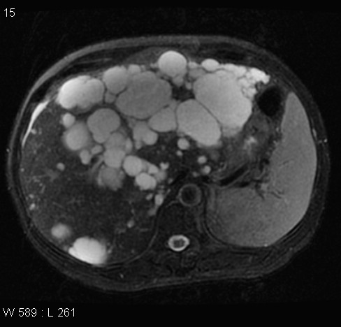 File:Autosomal dominant polycystic kidney disease (Radiopaedia 5202-6969 Axial T2 fat sat 5).jpg