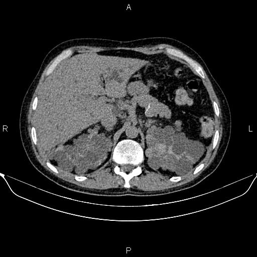 Autosomal dominant polycystic kidney disease (Radiopaedia 87830-104287 Axial non-contrast 16).jpg