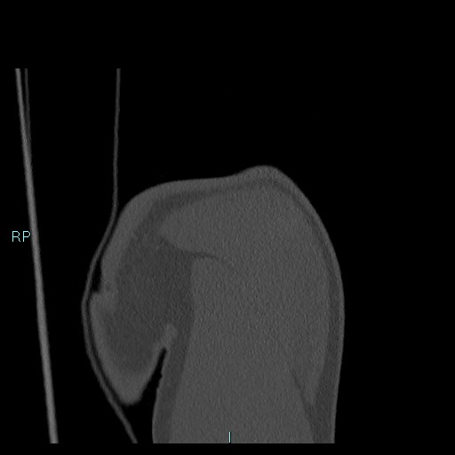 Avascular necrosis after fracture dislocations of the proximal humerus (Radiopaedia 88078-104655 Coronal bone window 32).jpg