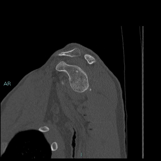 Avascular necrosis after fracture dislocations of the proximal humerus (Radiopaedia 88078-104655 Sagittal bone window 31).jpg
