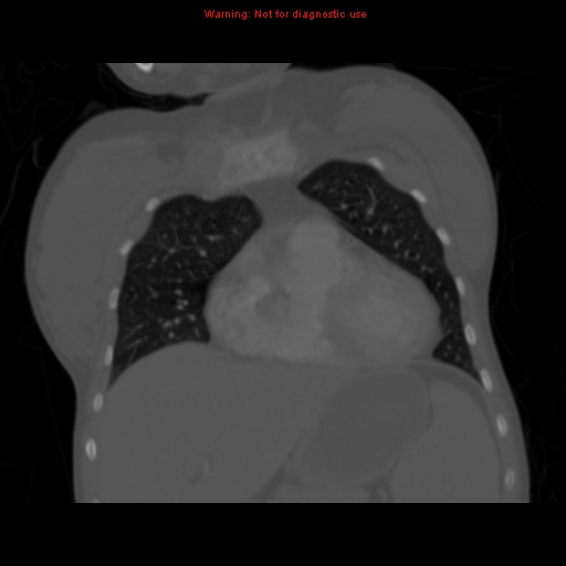 Avascular necrosis in sickle cell disease (Radiopaedia 17448-17152 Coronal bone window 36).jpg