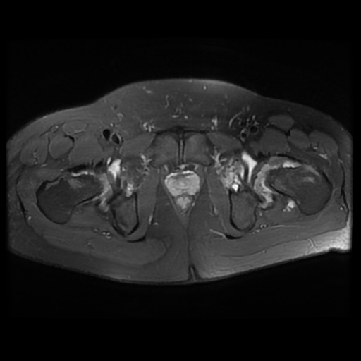 File:Avascular necrosis of the hip (Radiopaedia 61503-69465 Axial PD fat sat 21).jpg