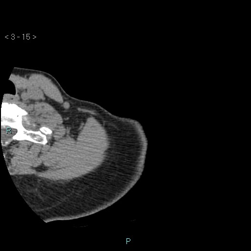 File:Avascular necrosis of the shoulder - Cruess stage I (Radiopaedia 77674-89887 Axial soft tissues 5).jpg