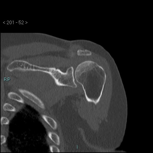 Avascular necrosis of the shoulder - Cruess stage I (Radiopaedia 77674-89887 Coronal bone window 51).jpg