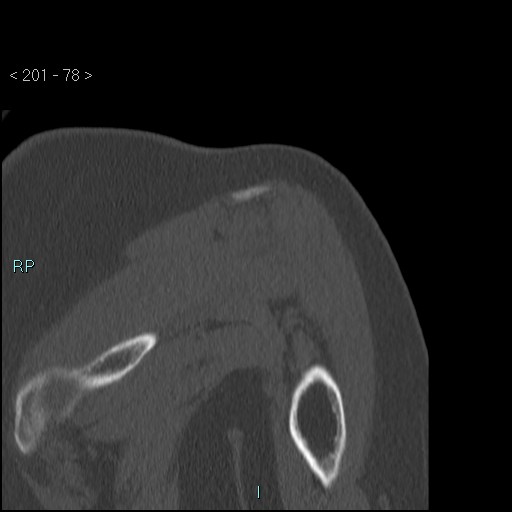 Avascular necrosis of the shoulder - Cruess stage I (Radiopaedia 77674-89887 Coronal bone window 77).jpg