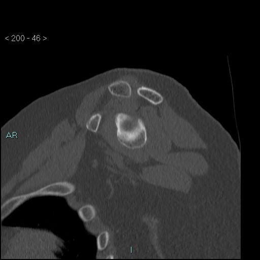 Avascular necrosis of the shoulder - Cruess stage I (Radiopaedia 77674-89887 Sagittal bone window 45).jpg