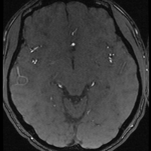 Azygos anterior cerebral artery (Radiopaedia 17059-16756 Axial MRA 31).jpg