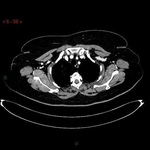 Azygos fissure and lobe (Radiopaedia 47620-52278 A 24).jpg