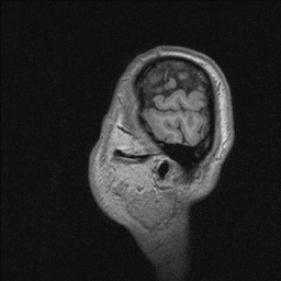 Balo concentric sclerosis (Radiopaedia 50458-55940 Sagittal T1 21).jpg