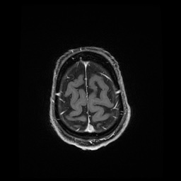 Balo concentric sclerosis (Radiopaedia 53875-59982 Axial LAVA C+ 232).jpg