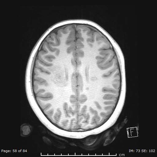 File:Balo concentric sclerosis (Radiopaedia 61637-69636 Axial T1 58).jpg