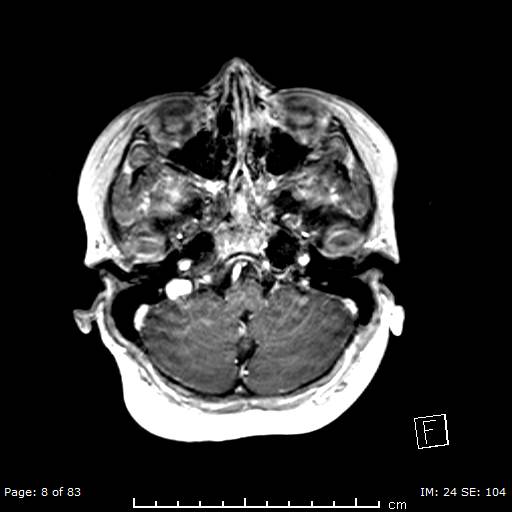 Balo concentric sclerosis (Radiopaedia 61637-69636 Axial T1 C+ 8).jpg